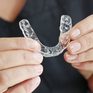 Aligner-Schienen eignen sich zur Korrektur von leichten oder wiederkehrenden Zahnfehlstellungen und rücken die Zähne sanft in die gewünschte Position.